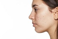 Treating Adult Acne