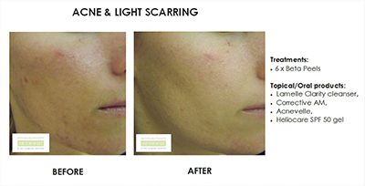 acne and light scarring before and after
