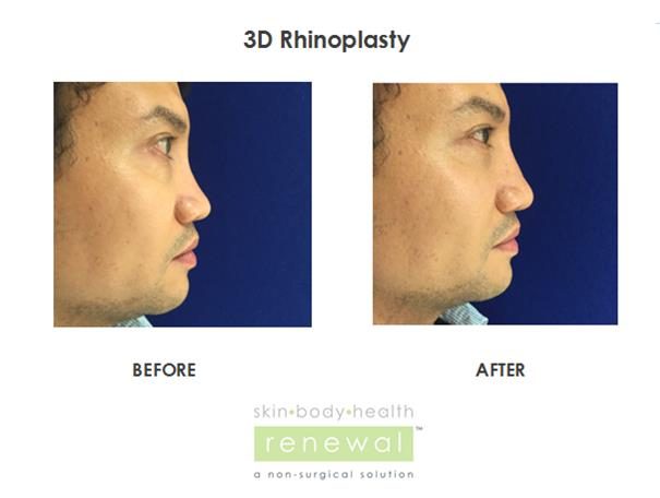 before after rhinoplasty
